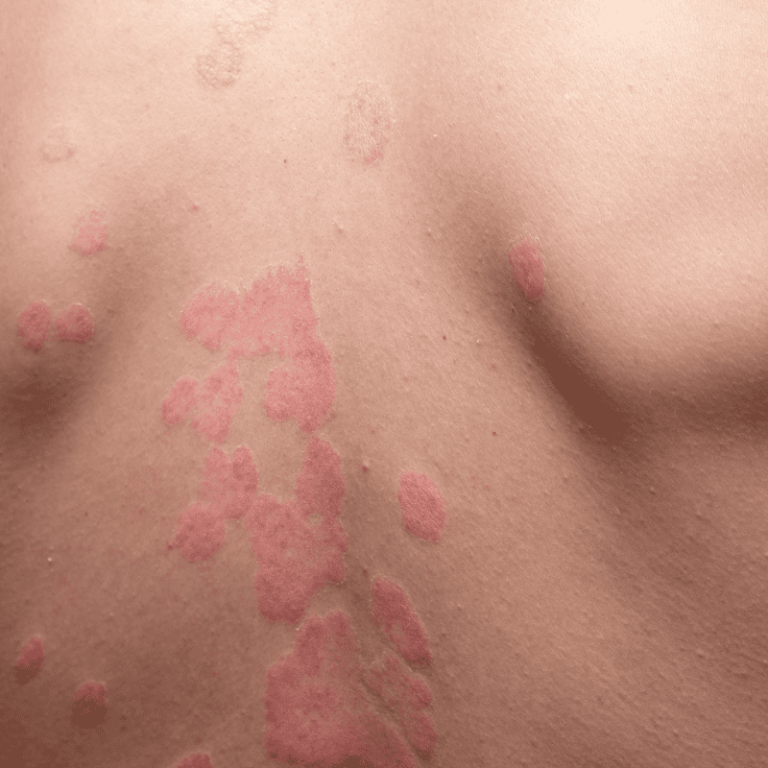 Psoriasis Care