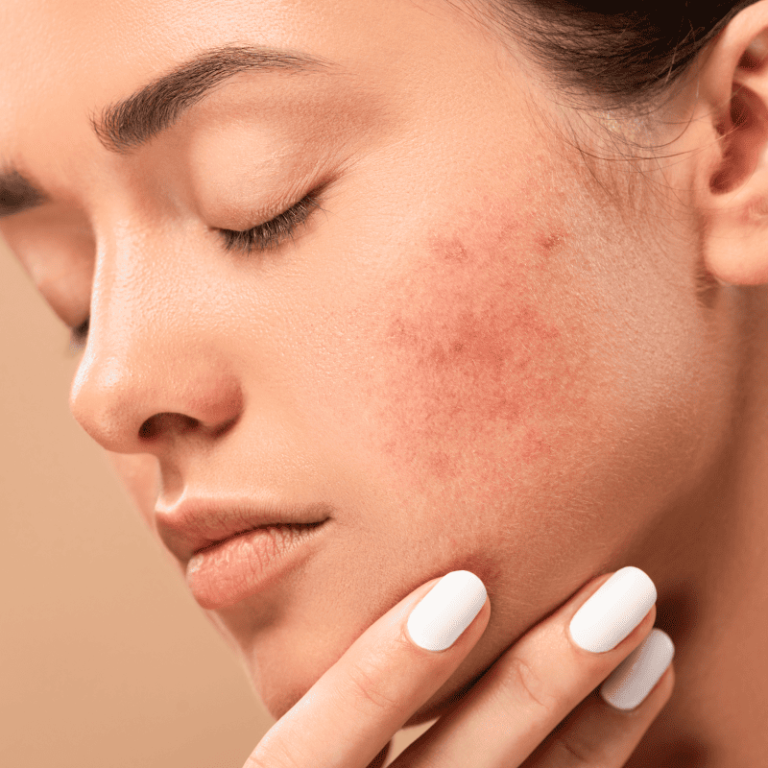 Rosacea Care