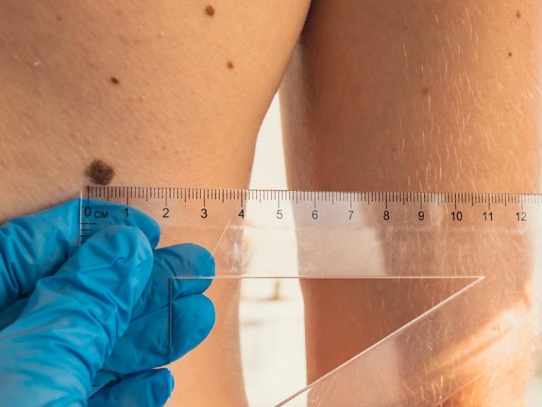 Mole Evaluation & Removal