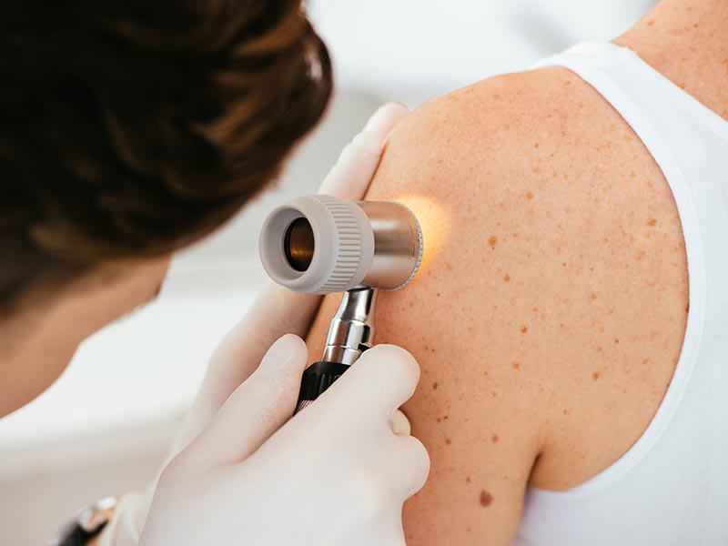 Skin Cancer Screening