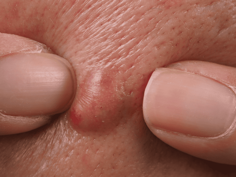 Warts & Wart Removal